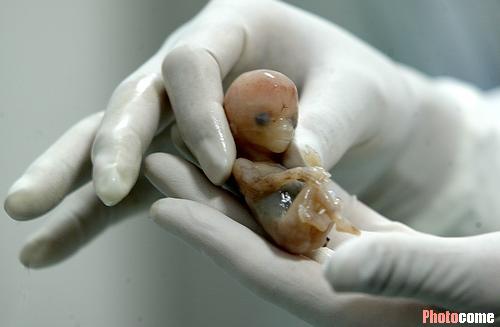 上海第一例“肝脏婴儿”被成功取出